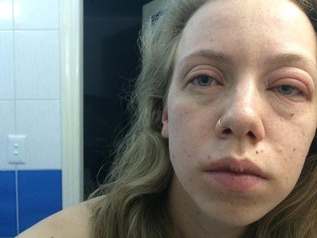 24. This girl who woke up like this on her trip to Cuba. She still doesn't know what she's allergic to.