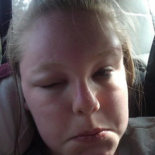 This girl who went to Florida and ended up in the hospital instead of on vacation. Sun allergies.