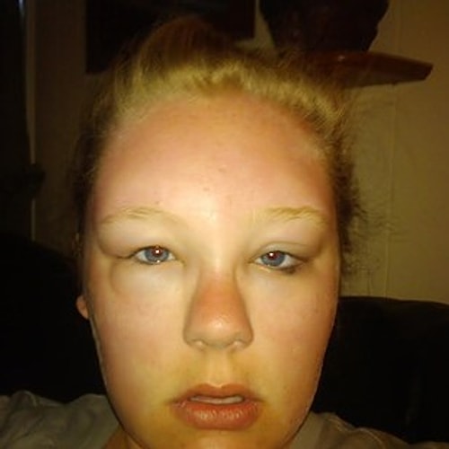 This girl who went to Florida and ended up in the hospital instead of on vacation. Sun allergies.