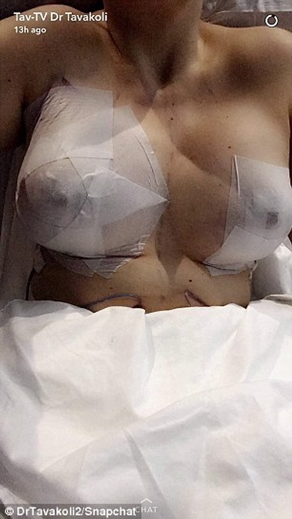 Tavakoli говорит, что благодаря каналу Snapchat ему удалось привлечь новых клиентов, так как после просмотра видео им было легче решиться лечь под нож.