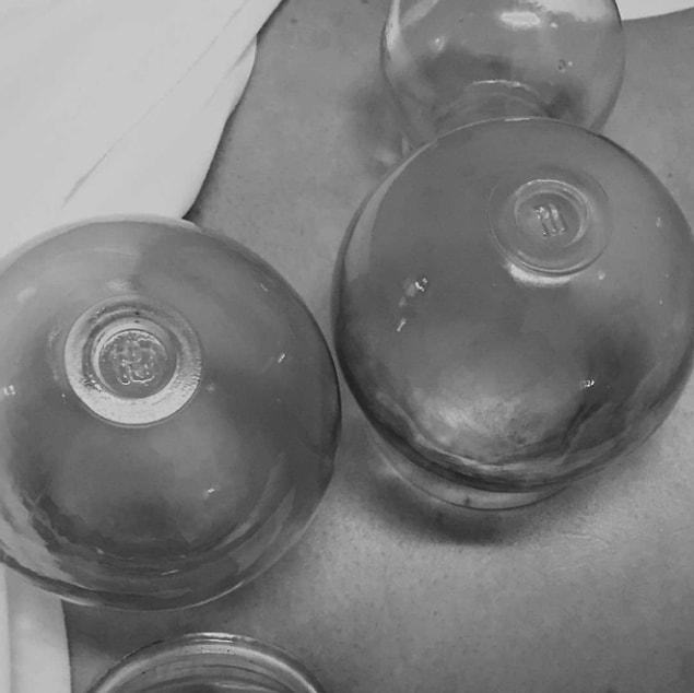 11. Everyone’s been talking about “cupping” a lot lately. But you have your own reasons. I see.