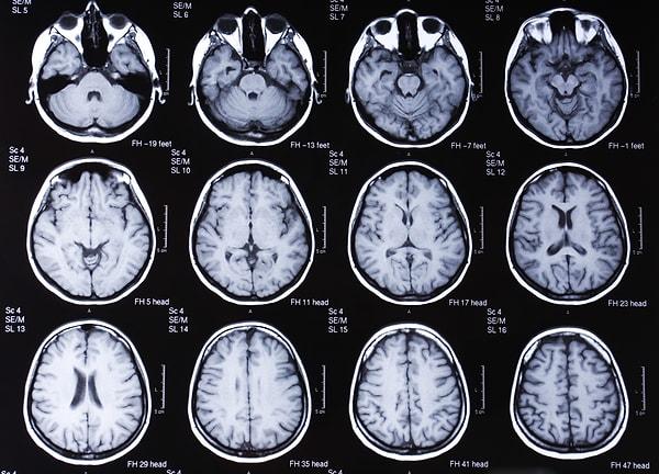 Beyin görüntülemesi için yüksek hassasiyetli MRI kullanan araştırmacılar, toplamda 900 kişi üzerinde çalıştı.