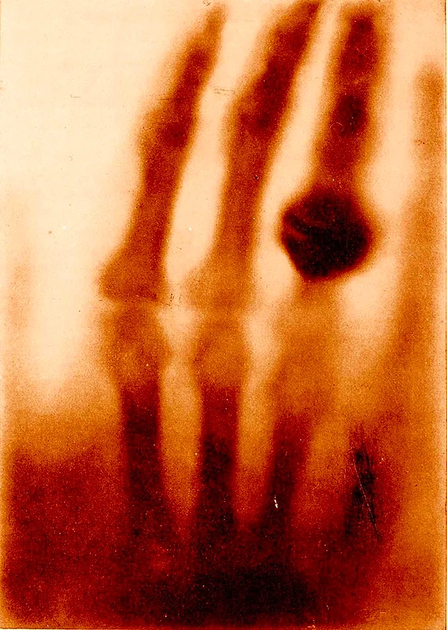 "Рука миссис Рентген", Вильгельм Конрад Рентген, 1895