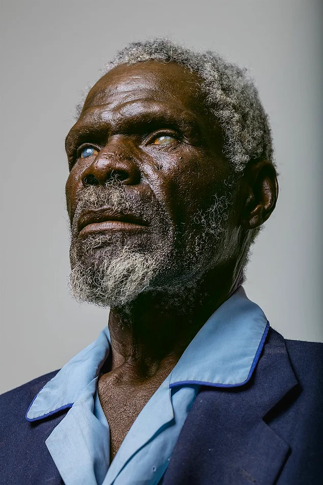 Герд Гаманаб, 67 лет, слишком поздно получил лечение. Проработав 50 лет под палящим солнцем Намибии, он полностью лишился зрения