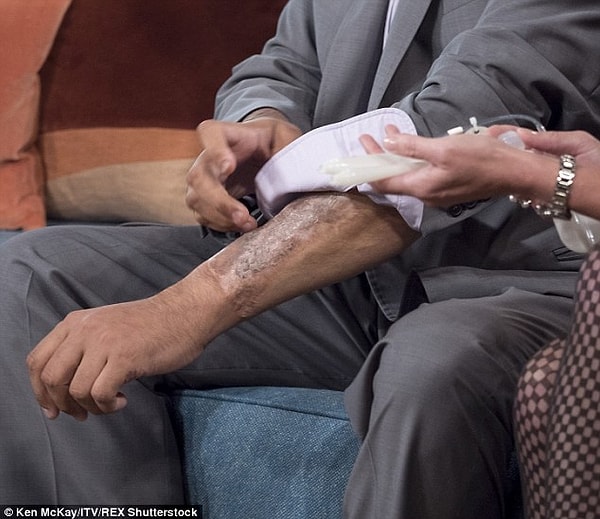 Хирурги вживили ему замену с кожей трансплантата, взятого из его руки.