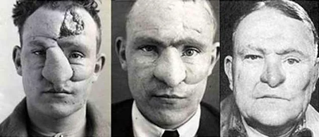 World War I Facial Reconstructions