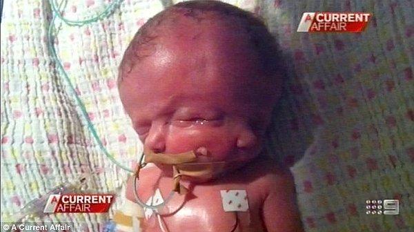 Bebek doğmadan önce doktorlar doğumun zorluğu hakkında aileye uyarılarda bulunuyordu. Fakat aile her şeyi göze alarak bebeği dünyaya getirmeye karar verdi.