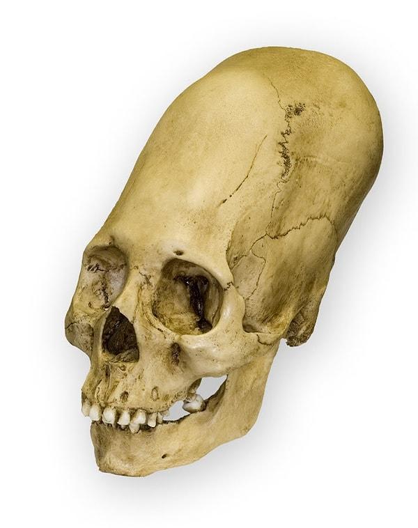 2. M.Ö 1000'li yıllarda kafatası uzatma Amerika ve Meksika'da oldukça yaygındı.