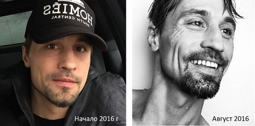 Дима Билан пугает поклонников своим болезненным видом!