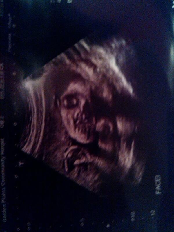 7. Реальная ультразвуковая фотография