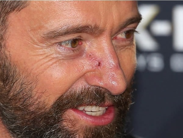 4. Базально-клеточный рак - это тип рака кожи, который возникает из-за ультрафиолетового излучения