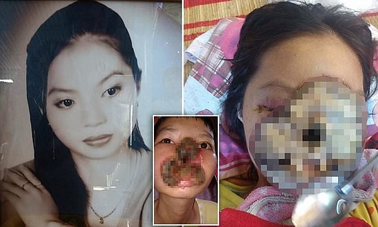 Genç Kadının Bütün Yüzünü Kaplayarak Ölüme Sürükleyen Burun Enfeksiyonu