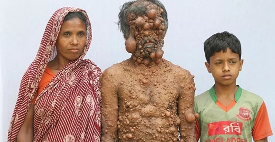 Отец троих детей может потерять зрение из-за многочисленных опухолей