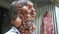 47-Year-Old Man Who Lives With Tumors Covering His Entire Body