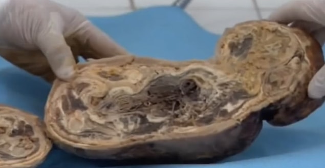 Woman Pregnant For 46 Years Gives Birth To Stone Baby Onedio Co
