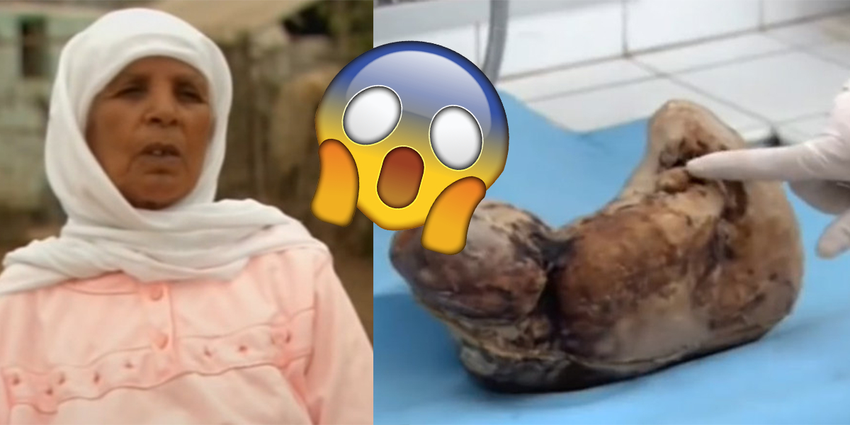 Woman Pregnant For 46 Years Gives Birth To Stone Baby Onedio Co