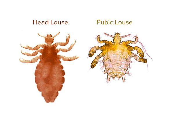 6. Pubic lice are six-legged creatures that infest the hair in the pubic area.