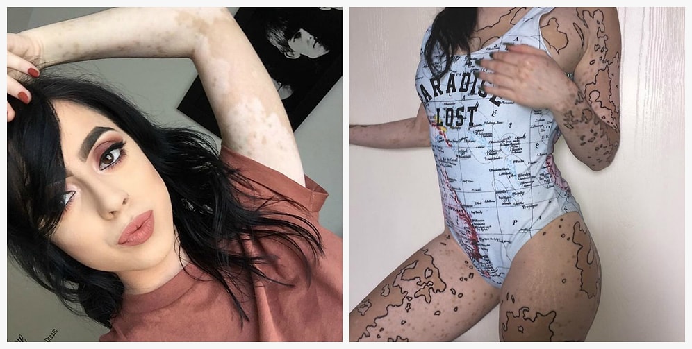 Девушка, страдающая витилиго, превратила свое тело в произведение искусства