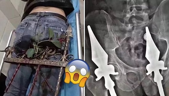 İkinci Kattan Demir Çitin Üstüne Düşünce Poposuna Demir Parçası Saplanan Zavallı Adam