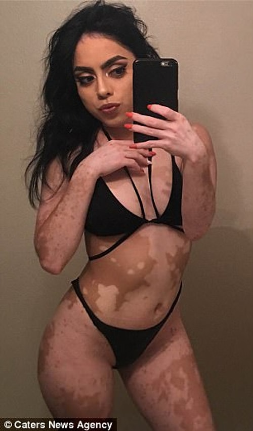 Ashley Soto, 21, from Orlando, Florida, was diagnosed with vitiligo at the age of 12 and had white spots on her body because of it.