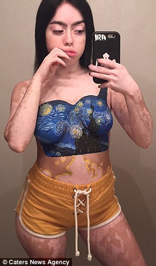 Ashley Soto, 21, from Orlando, Florida, was diagnosed with vitiligo at the age of 12 and had white spots on her body because of it.