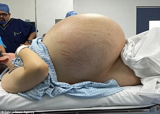 Last year, Dr. Erik Hanson Viana at Mexico's General Hospital performed the pioneering surgery to remove the cyst - believed to be the biggest-ever removed.