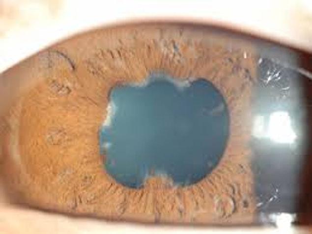 The rupture and disintegration of this membrane surrounding the iris, which is the colored part of the eye, is very rare.