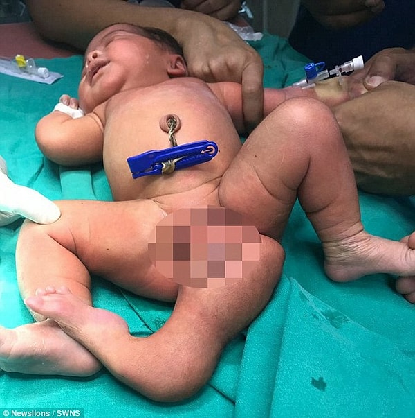 3. Доктор Шринивас, принимавший роды у Шрилаты, рассказал, что третья конечность росла у девочки прямо из паха