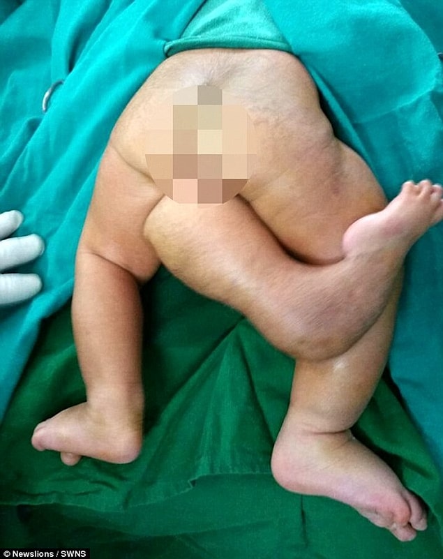 But there was a very rare birth anomaly in the born baby. The baby came to the world with 3 legs.