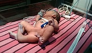 A Mother Gave Birth To A 3-Legged-Baby In India And Had To Go Through A Painful Surgery!