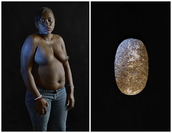 8. В результате деформации груди разрушаются молочные железы, и девочка уже не сможет кормить своего ребенка грудью