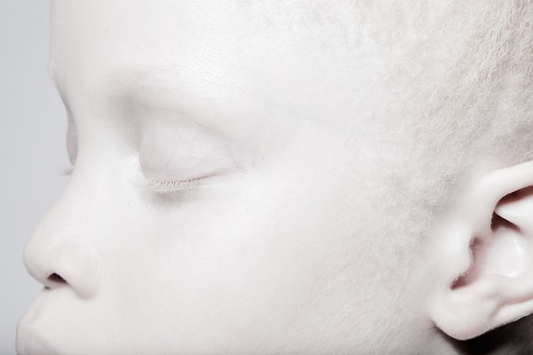 3. В 2016 году необычная внешность близнецов привлекла внимание швейцарского фотографа