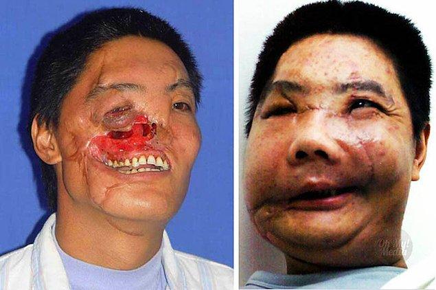 5. Ayı saldırısı sonucunda yüzü parçalanan Li Guoxing, 2006 senesinde yüz nakil ameliyatı geçirmiş.