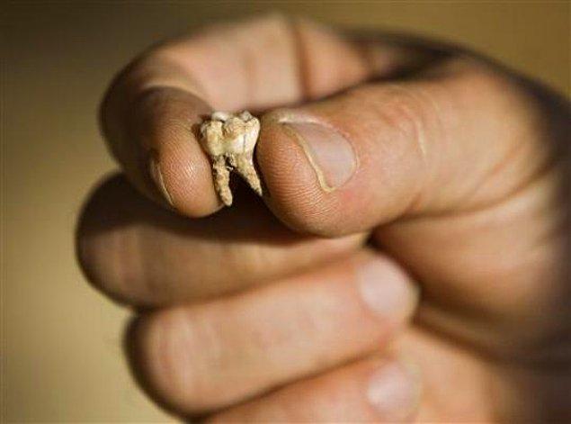 Diş hekimleri dişin hassas, çürük kısmını keskin aletlerle oyuyor ve sonra da oyuğun içini kor metalle dolduruyordu.