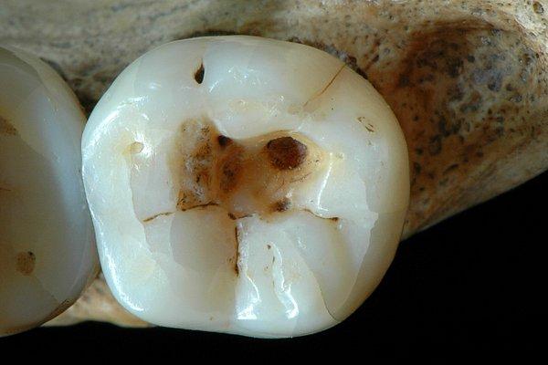 Araştırmacılar dişi incelediklerinde dişin çiğneyici yüzeyinde olan ve içinde 4 ufak delik olan büyük bir delik keşfetti.