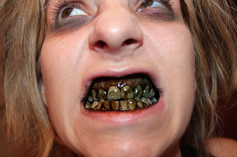 Diş Çürümesi ve Diş Çekimi ile Alakalı Okudukça Dişinizi Ağrıtacak Kadar İlginç Bilgiler