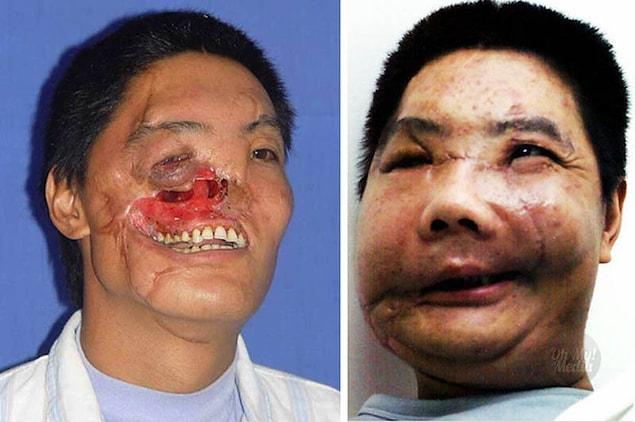 5. Li Guoxing, of China, lost much of his right face when he was attacked by a bear. He received a partial-face transplant in 2006.
