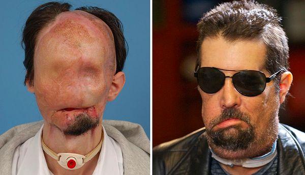 8. Dallas Wiens, of Texas, suffered nearly fatal burns over most of his head after the construction lift he was riding hit a power line. He received a full-face transplant in 2011.