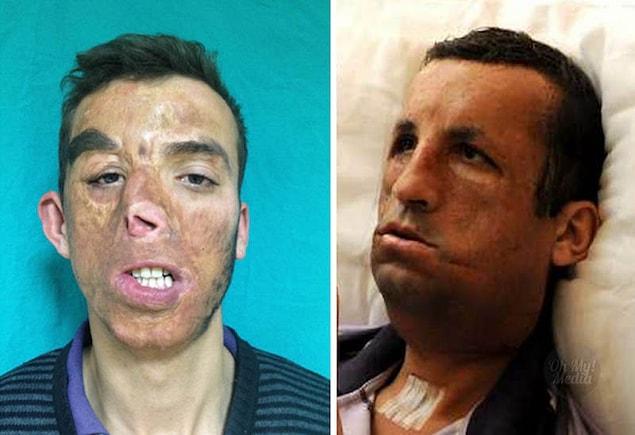 11. Ugur Acar, of Turkey, suffered serious burns to his face during a house fire. He received a full-face transplant in 2012.
