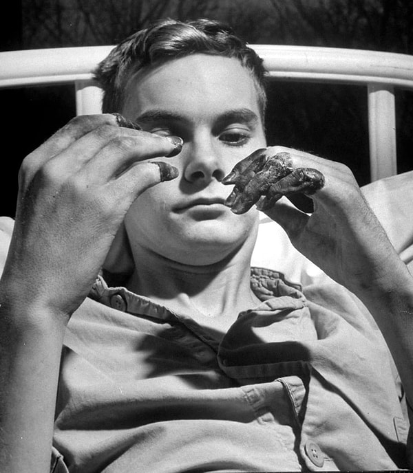 11. Американский солдат Джон Болдридж, пострадавший от обморожения, рассматривает свои увечья в госпитале Перси Джонса в Батл Крике (1951 год)