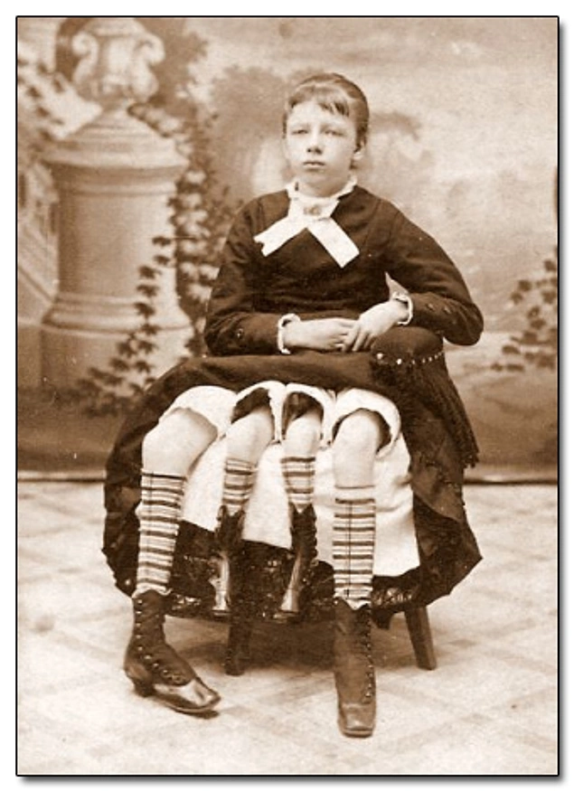 Myrtle Corbin, who was born in 1868 as a dipygus, which is a medical term for having an extra pelvis.