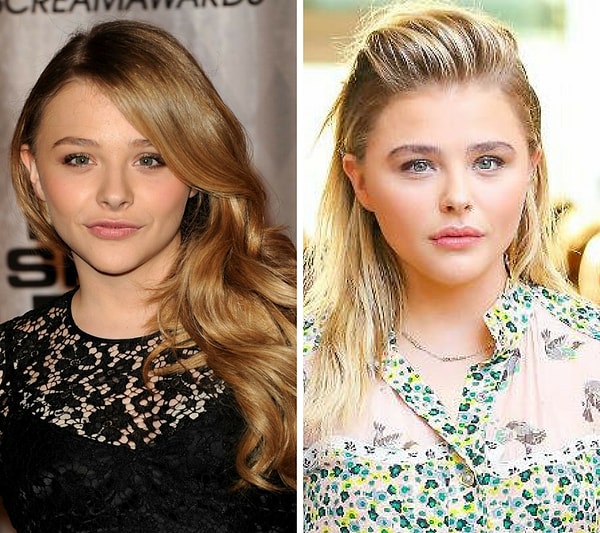 Chloë Grace Moretz Plastic Surgery Speculation Nose Job & Lip Fillers