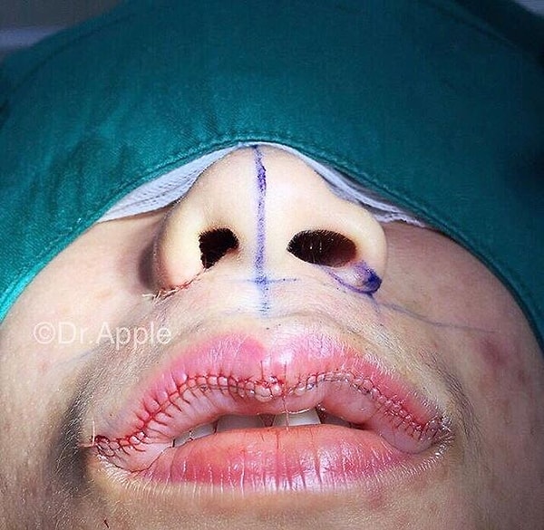 3. Операция проводится под местной анестезией и длится 15-30 минут. 7 дней после операции пациенту рекомендуется пюреобразная диета.