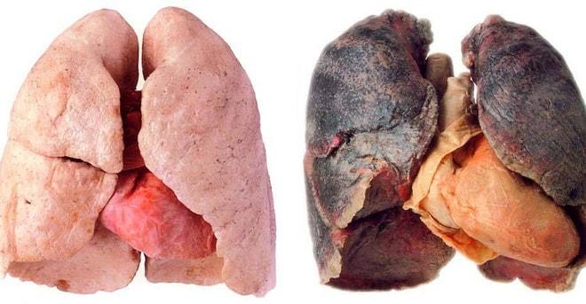 Sigara Tiryakilerine Alışkanlıklarını Sorgulatacak Bir Akciğer Hastalığı: KOAH