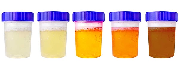 6. Цвет вашей мочи может многое рассказать о вашем здоровье