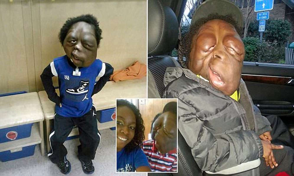 Yüzünün Şekli Dev Tümörler Sebebiyle Bozulmuş 8 Yaşındaki Çocuğun Üzücü Hikayesi