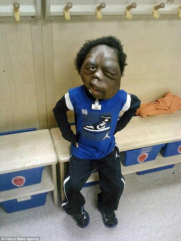 Amare Stover was called a 'monster' by cruel bullies because he was born with neurofibromatosis type one (NF1).