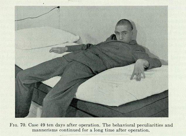 10. Doktor Walter Freeman'ın lobotomi tedavisi uyguladığı hastalarından birinin operasyondan 10 gün sonra çekilmiş fotoğrafı, yıl 1942.