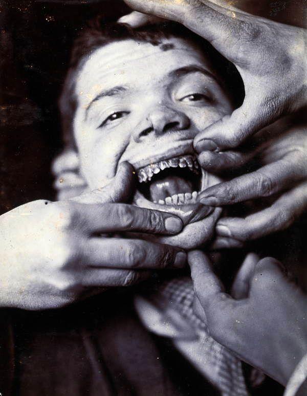 11. A young patient's rotted teeth, due to poor dentistry, are shown at London's Friern Hospital (previously known as the Colney Hatch Lunatic Asylum) circa 1890-1910.