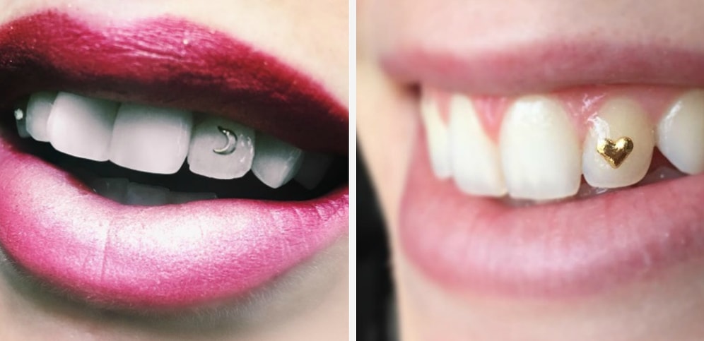 Модный круговорот: стразы на зубах вернулись к нам из 90-х  и снова стали трендом